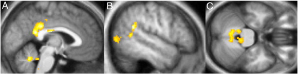 MBSR mindfulness fmri